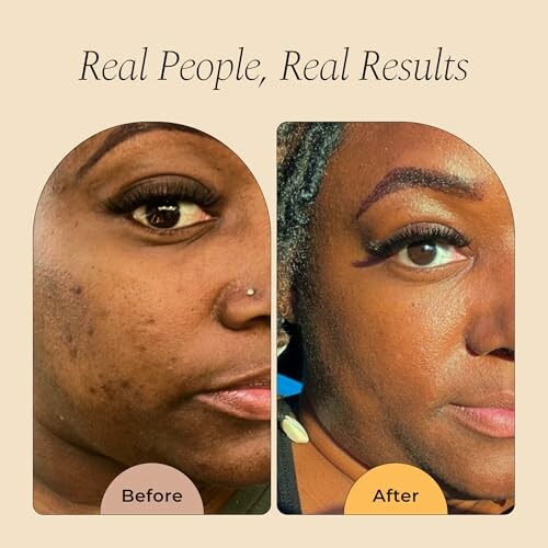 Before and after skin treatment comparison on a woman's face.