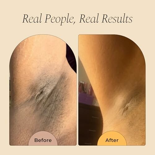 Before and after skin care treatment on underarm.