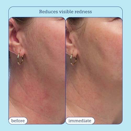 Side-by-side comparison showing reduced skin redness on a woman's cheek before and after treatment.