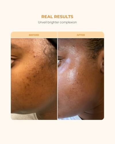 Comparison of skin before and after treatment showing improved complexion.